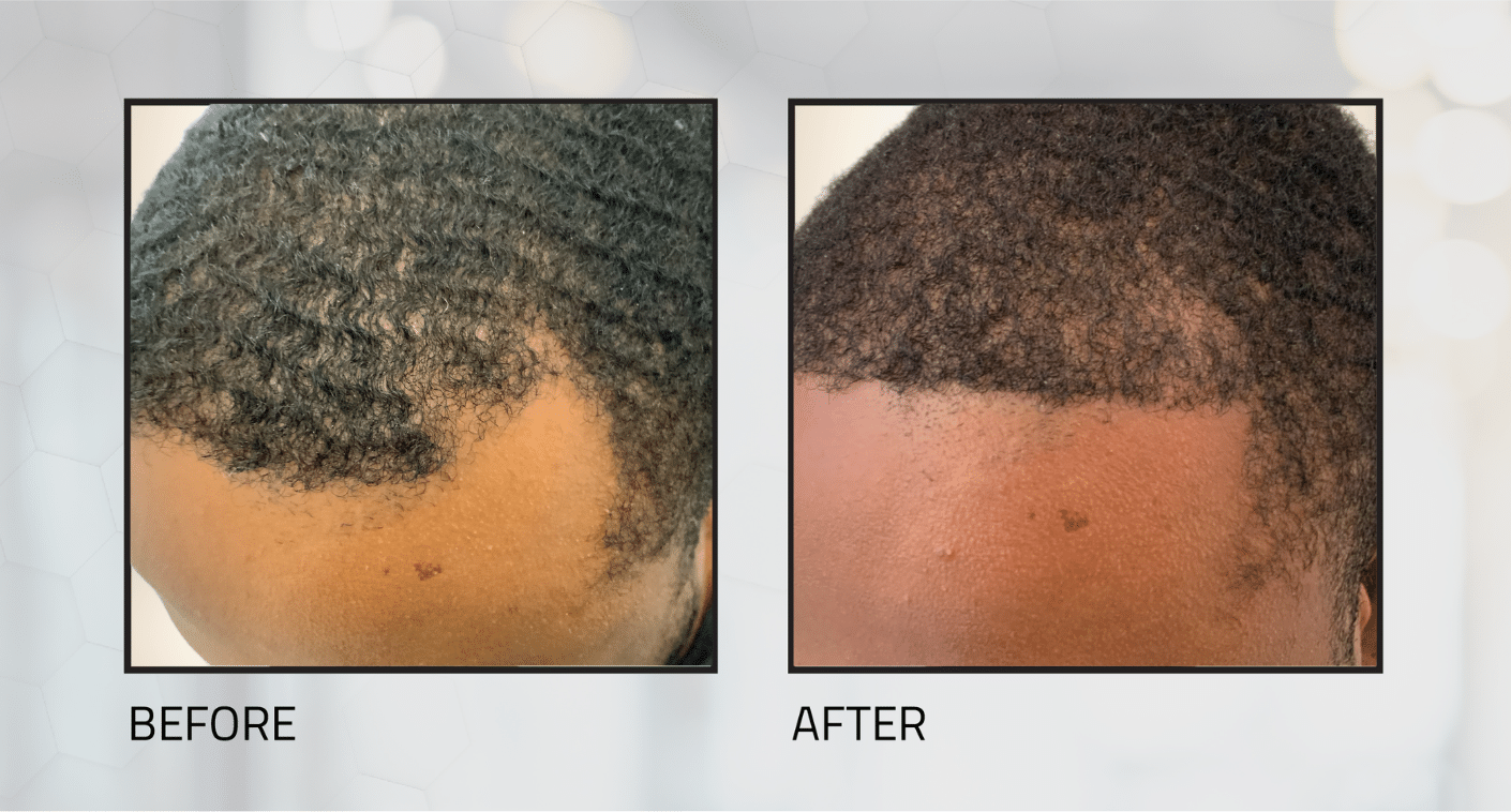 Black hair transplant before and after