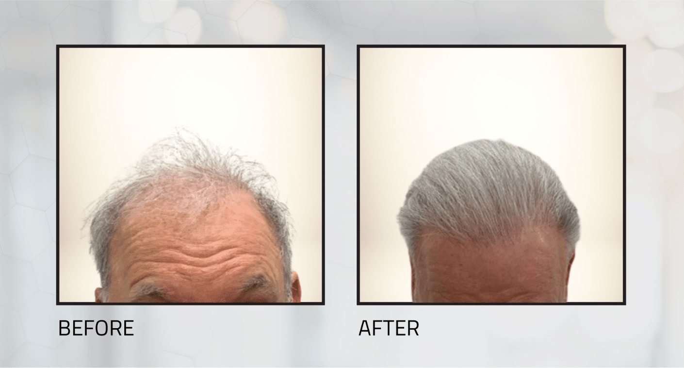 Restored Hairline Results Before and After