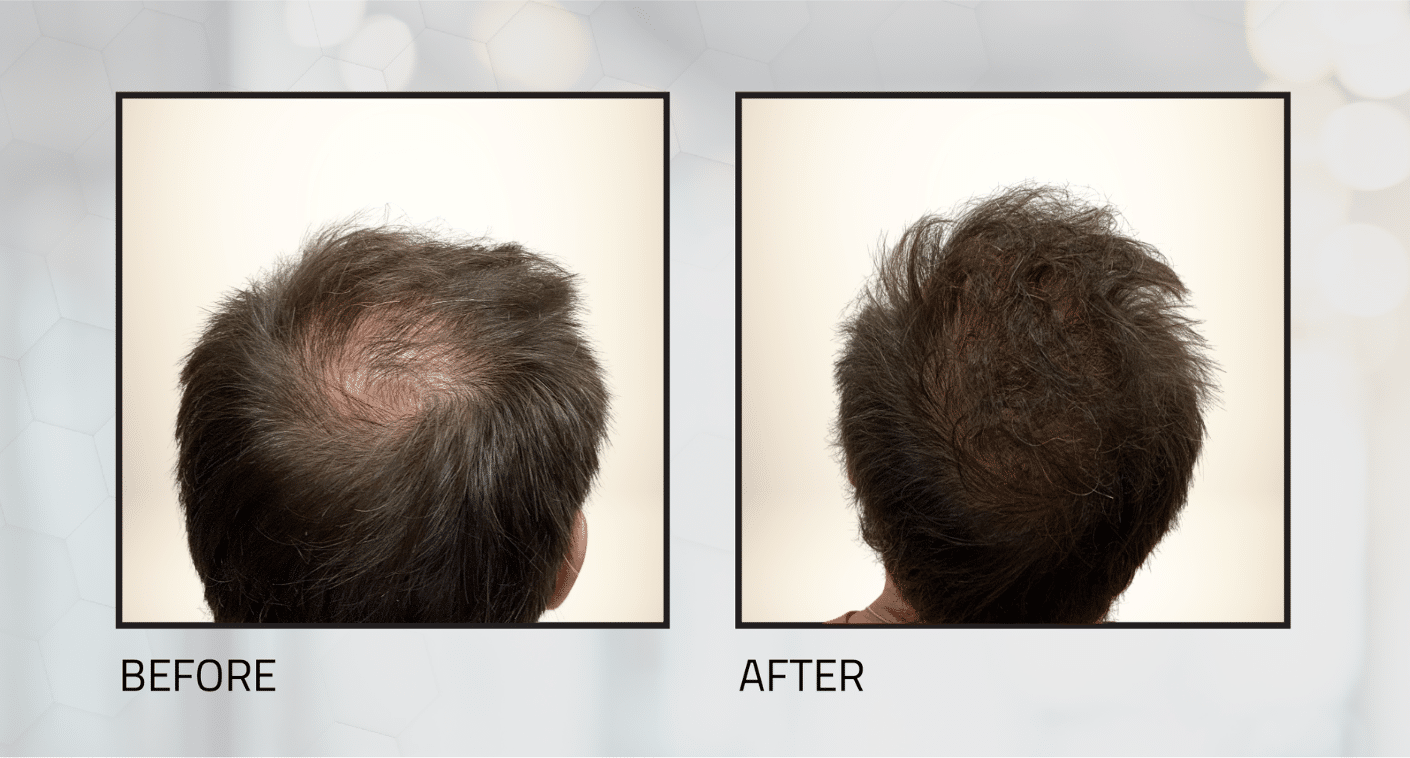1800 grafts shave-less fue before and after