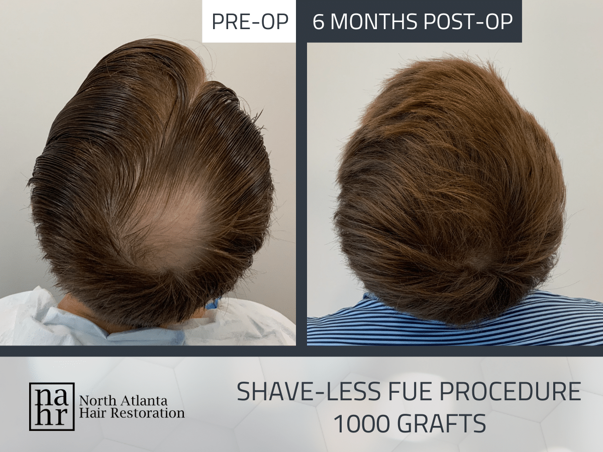 hair restoration success before and after'