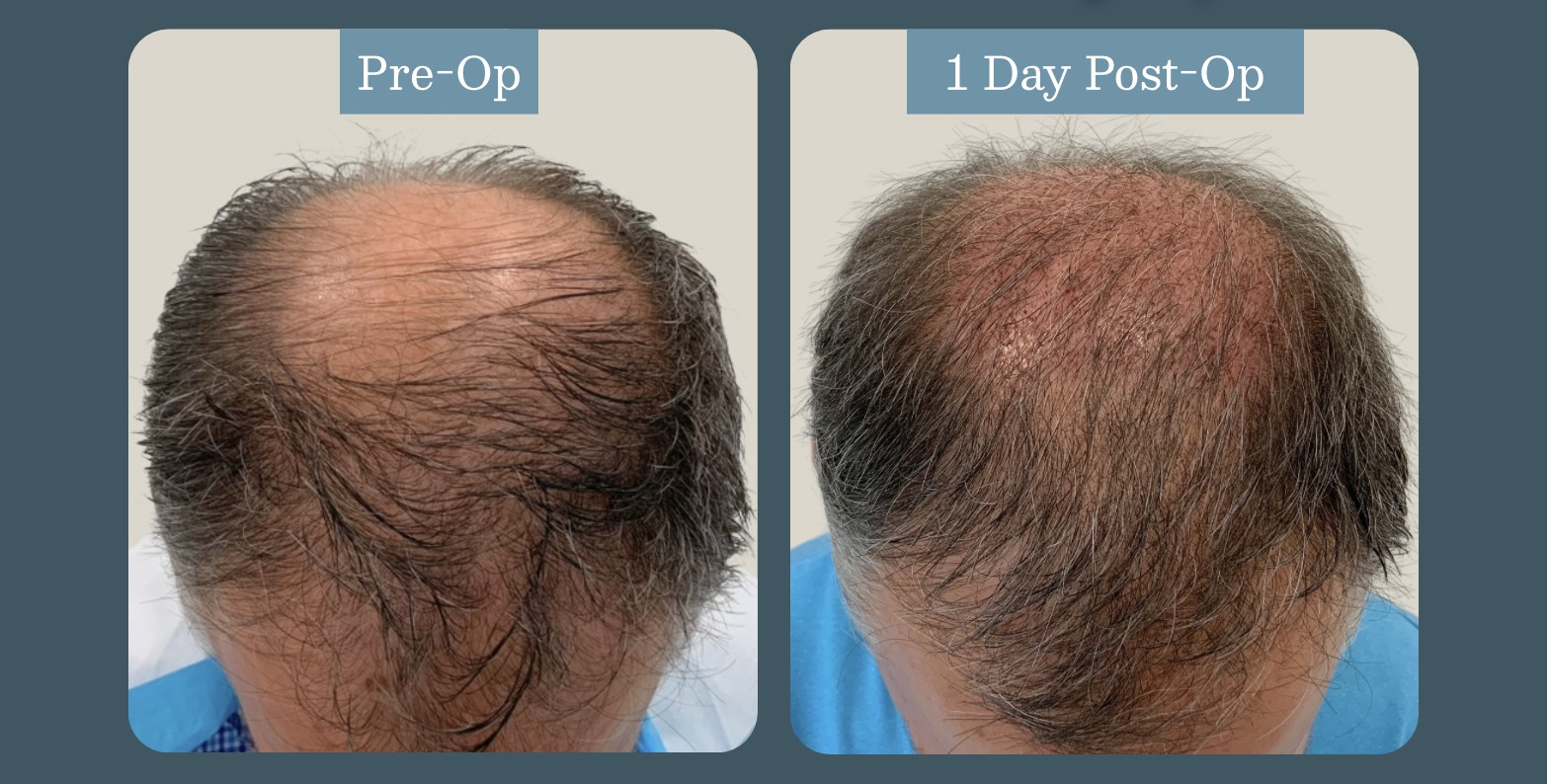 Donor site concealment: pre-op vs. one day post-op (1,500 graft shave-less FUE case)