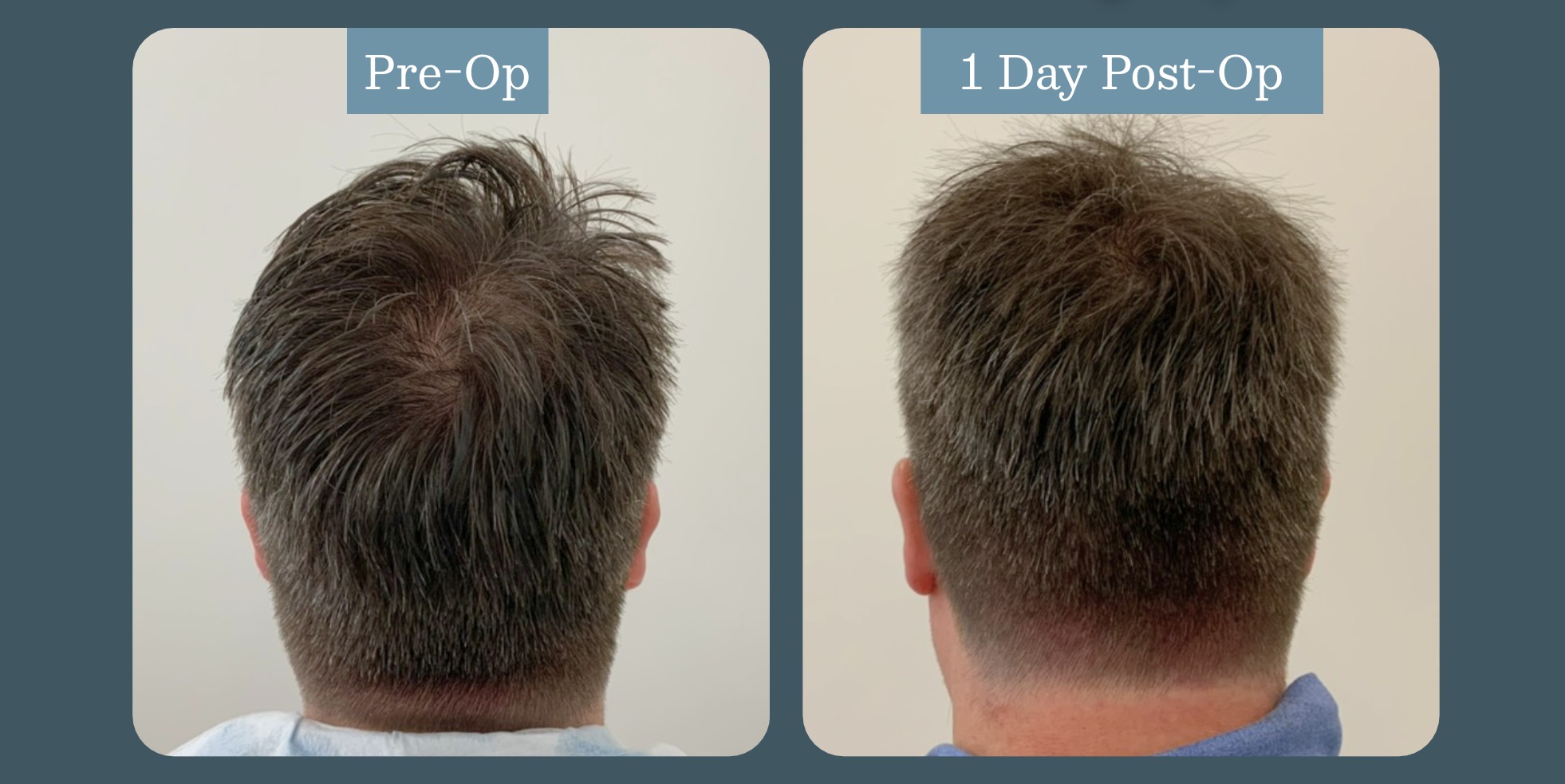 Recipient site: pre-op vs. one day post-op (1,750 graft shave-less FUE case)