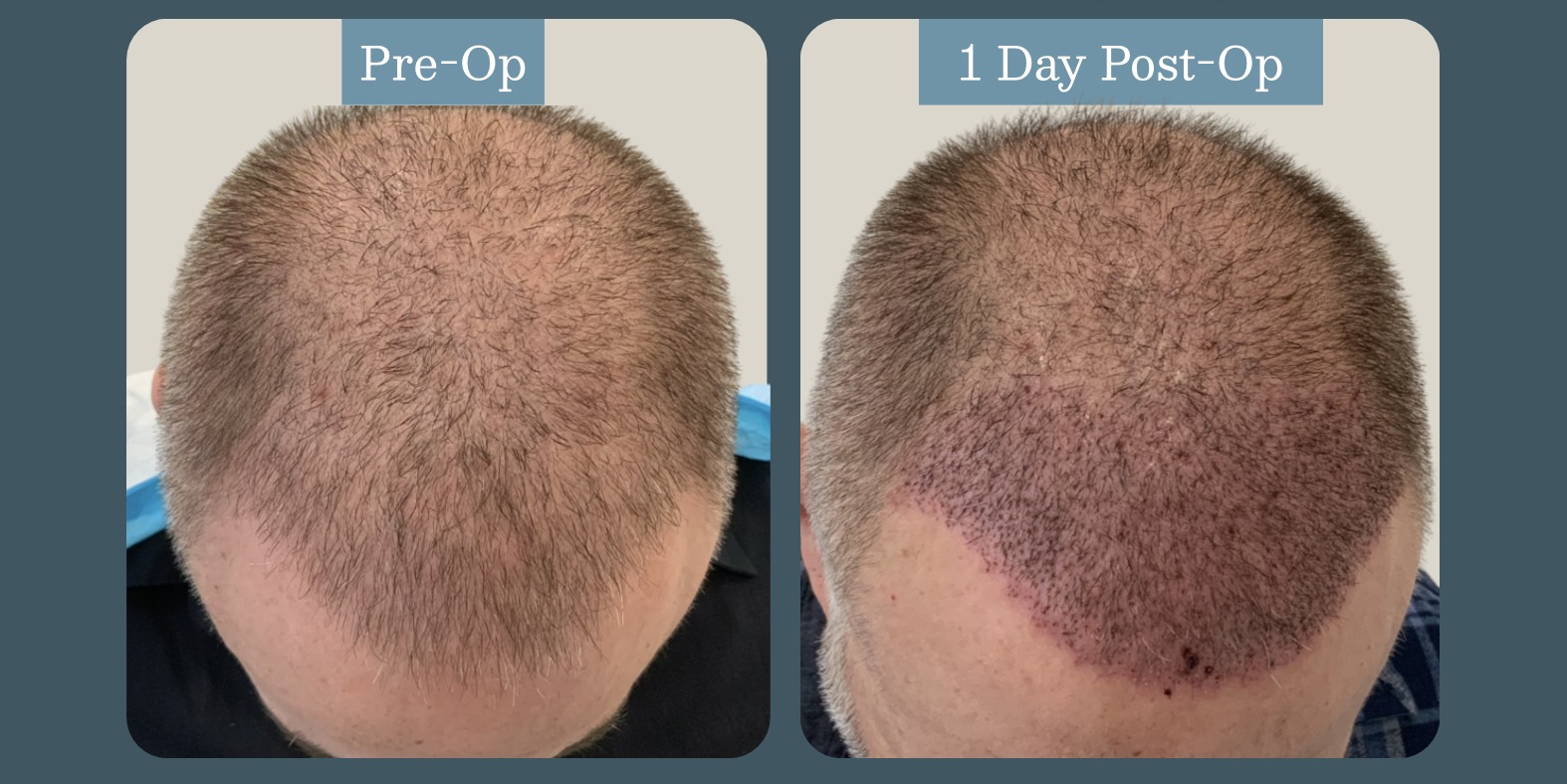 Immediate visualization of coverage: pre-op vs. one day post-op (2,500 graft long hair FUE case)