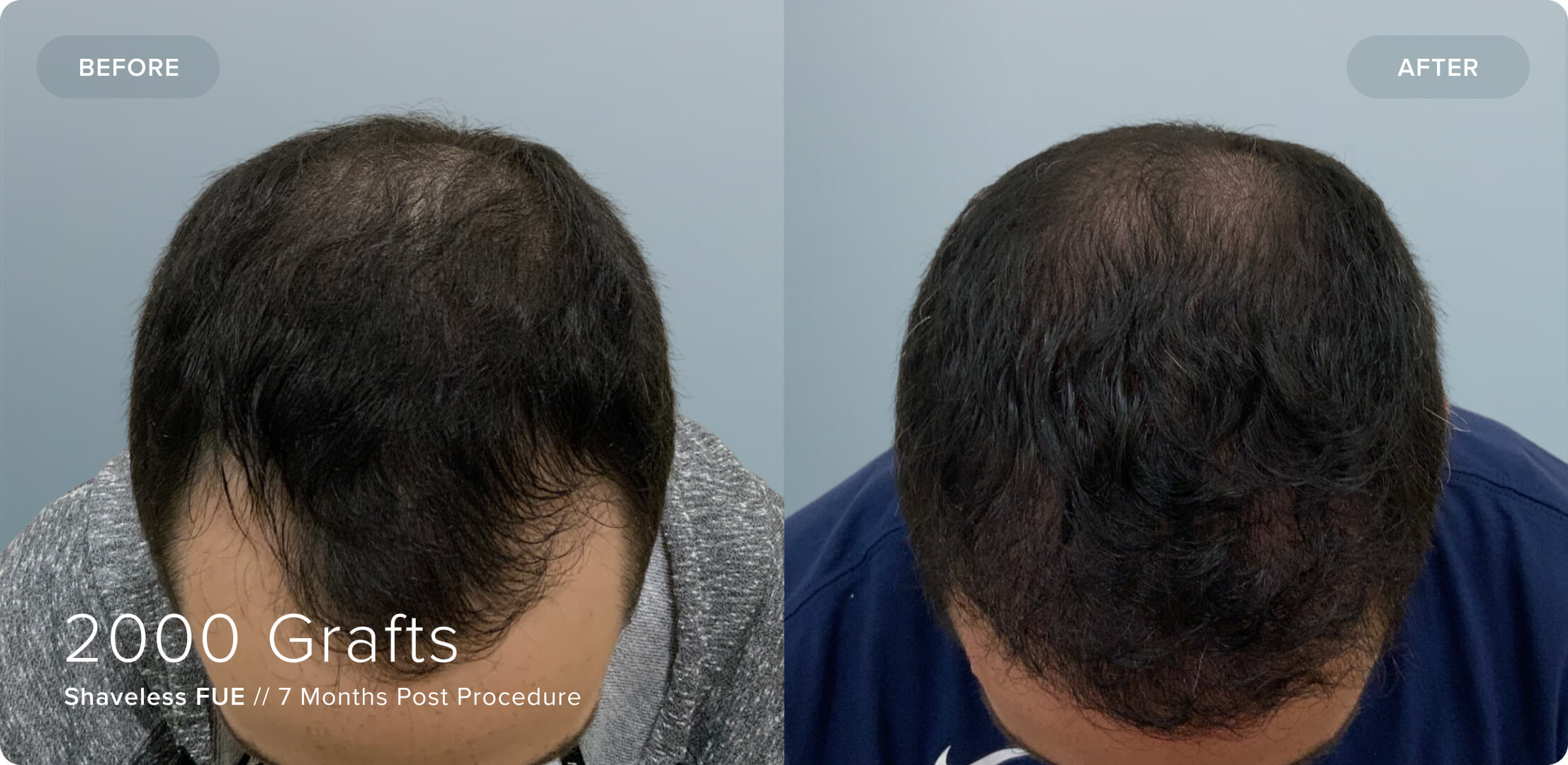 Shaveless_MR_Results