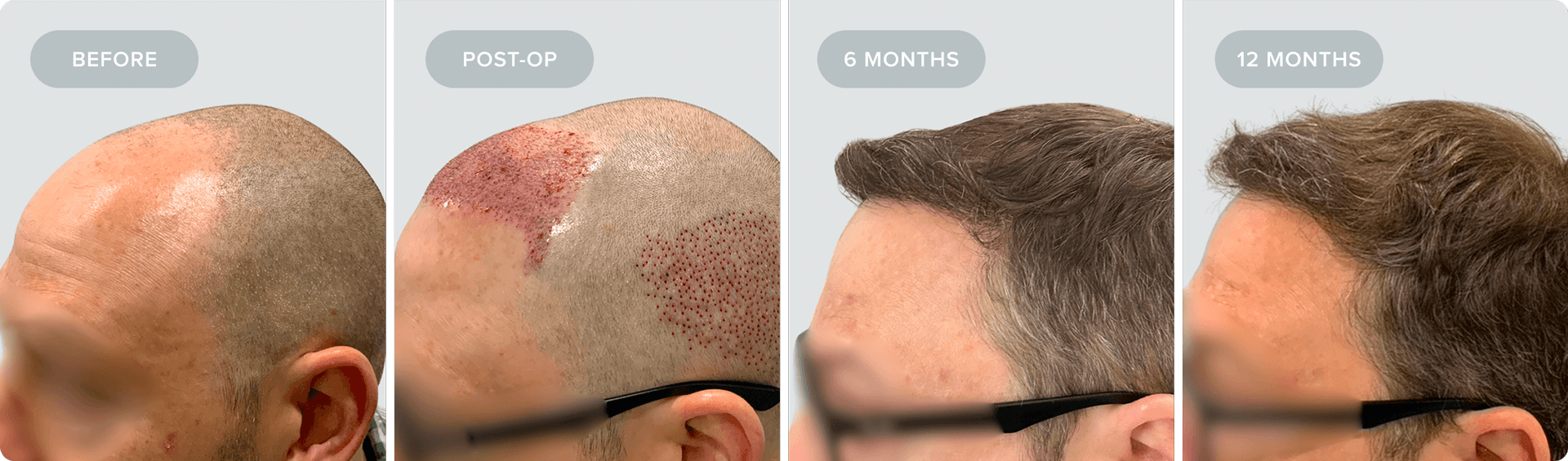 Shaved_Recovery-JB