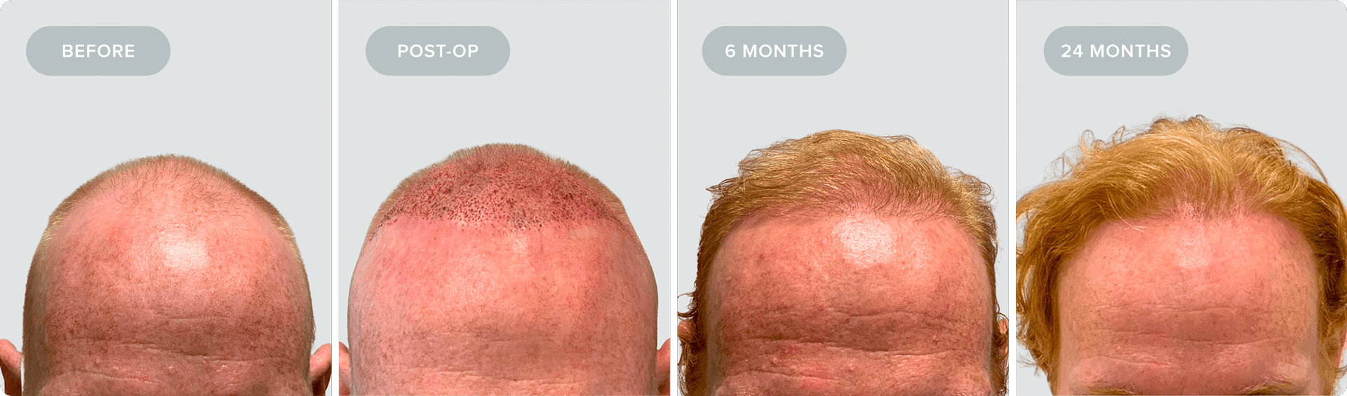 Shaved_Recovery-JC