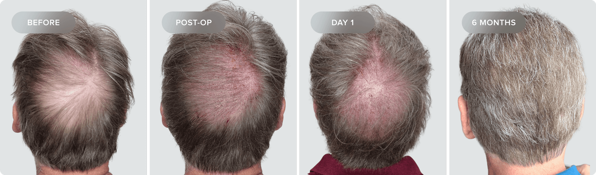 Shaveless_Recovery-DS