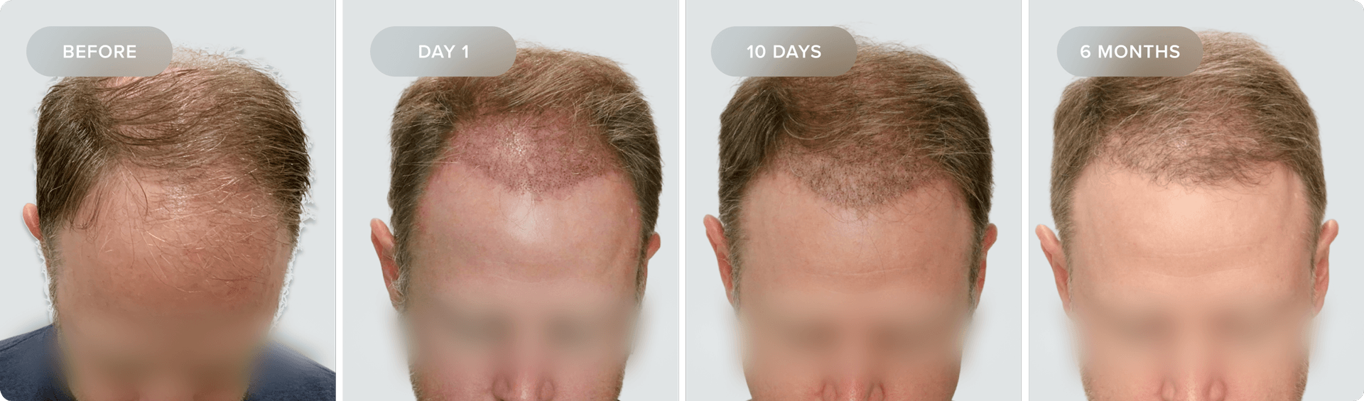 Shaveless_Recovery-MT
