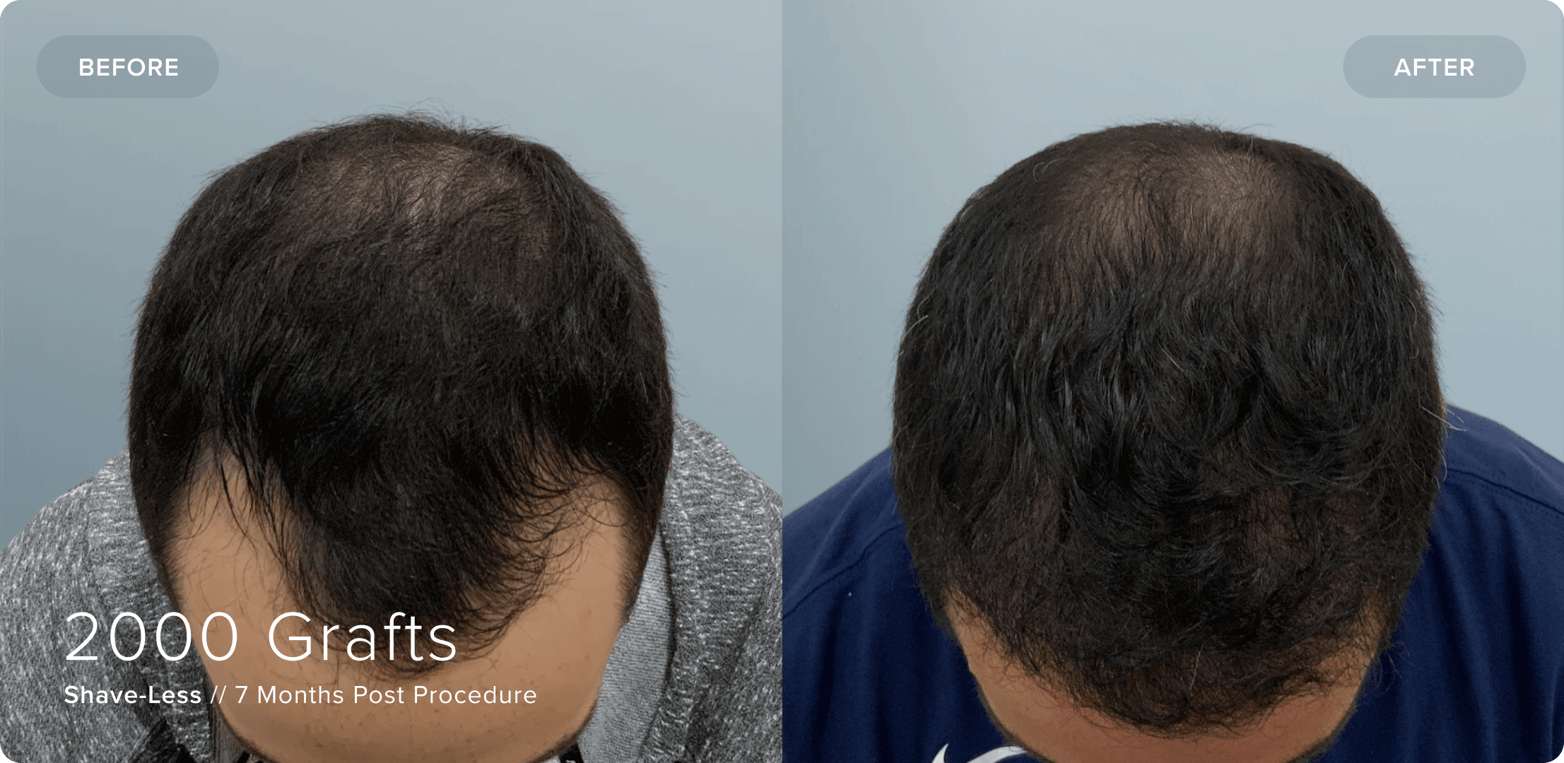 04 Shaveless_MR_Results