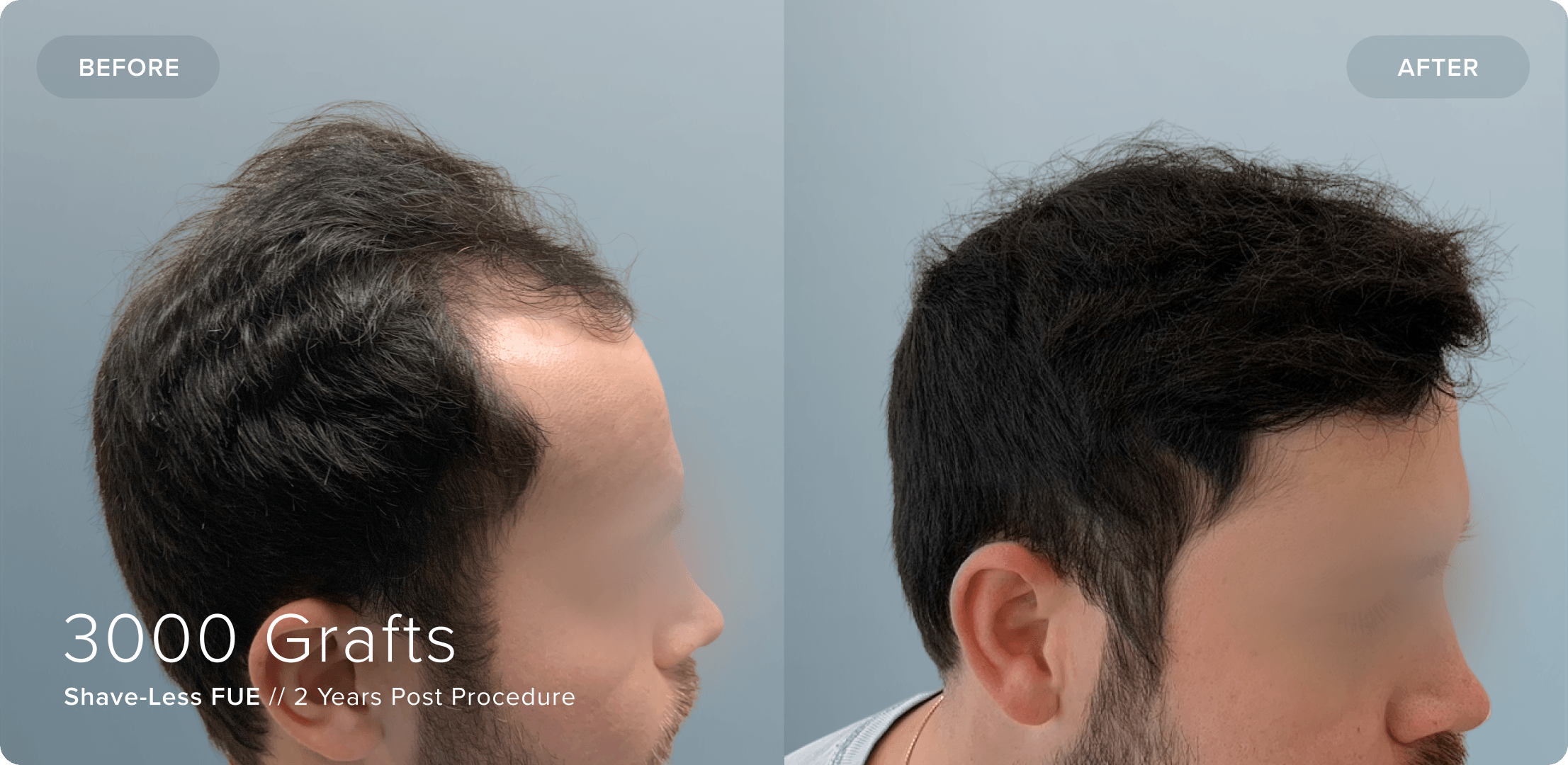 12 Shaveless_BL_Temporal_Results