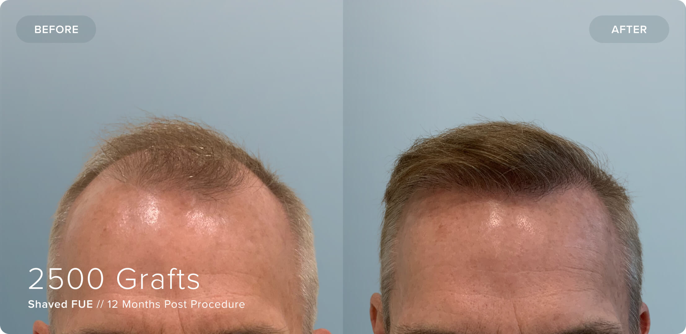Shaved_TH_Results